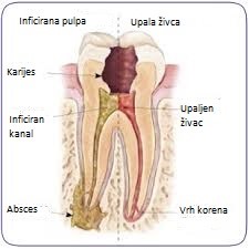 lecenje zuba